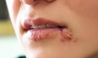 艾滋病初期红点图片 艾滋病初期红点图片